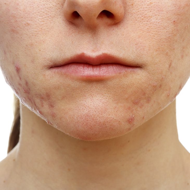 Cicatrizes de acne